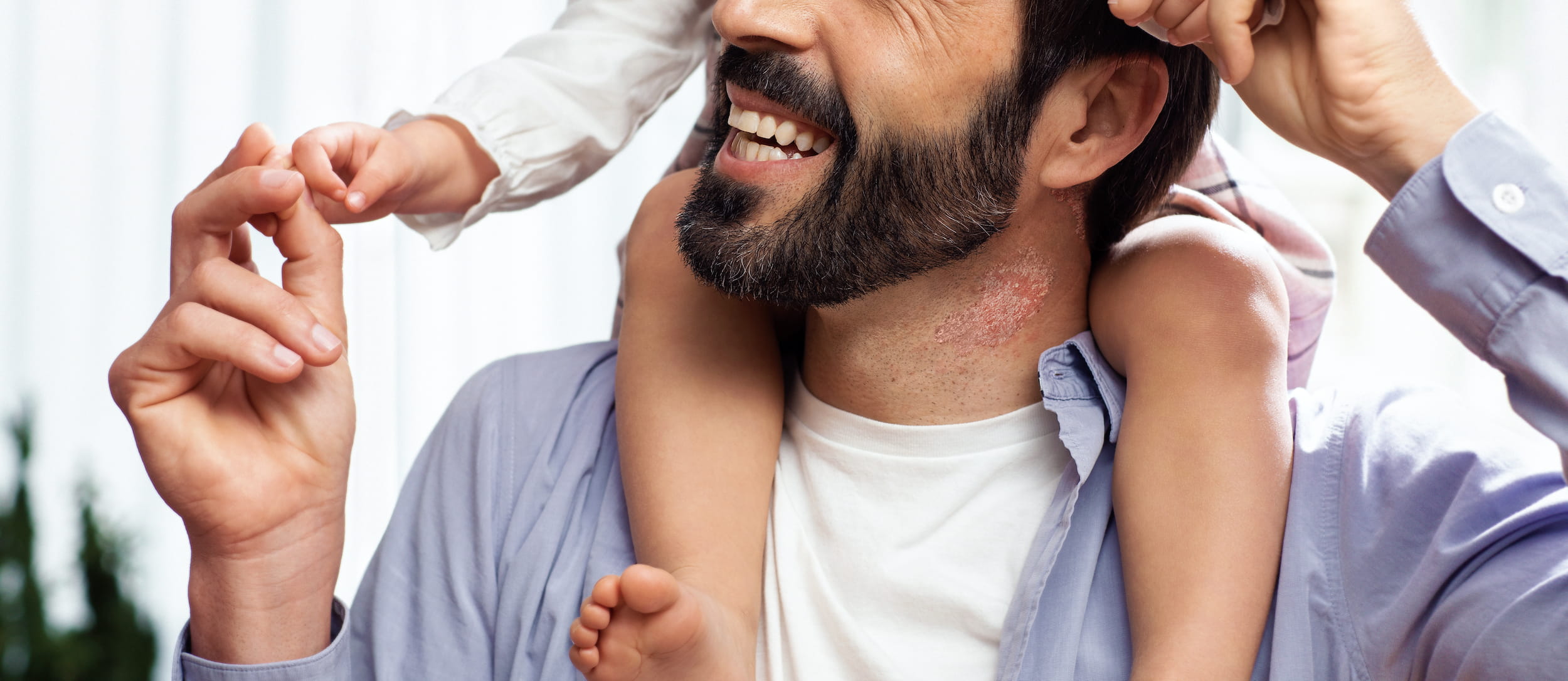 Psoriasis