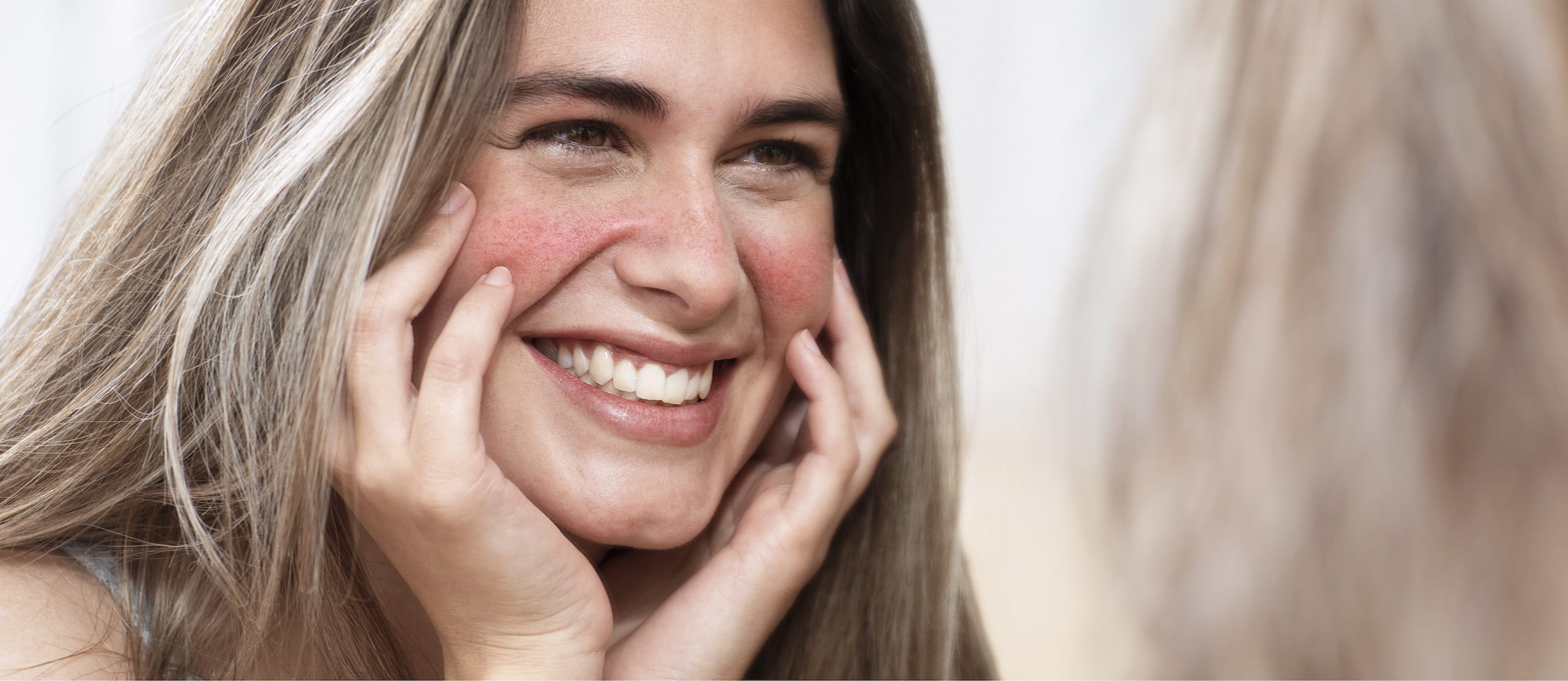 Rosacea